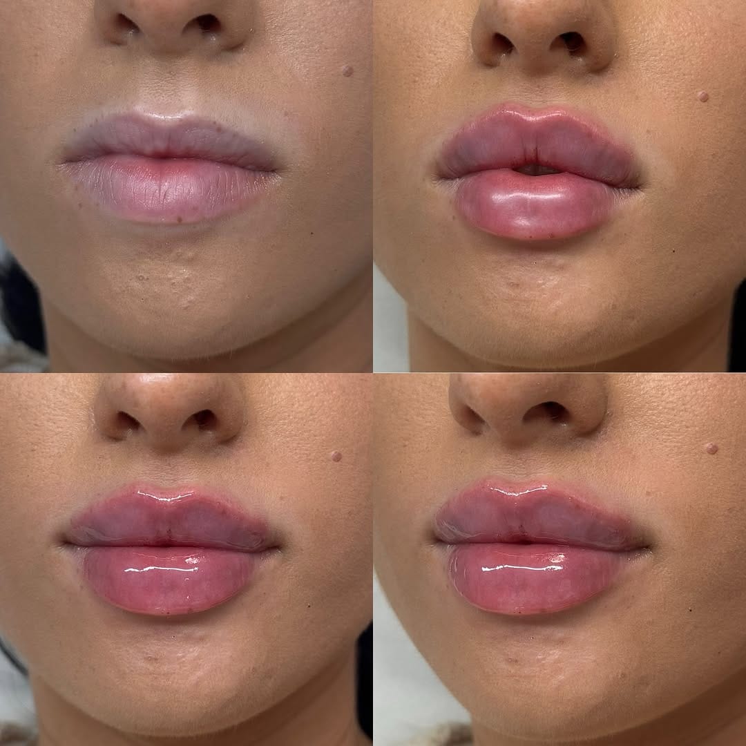 Post 5 by Inara Babamir | Piercer & Cosmetic Injector on Instagram (image)