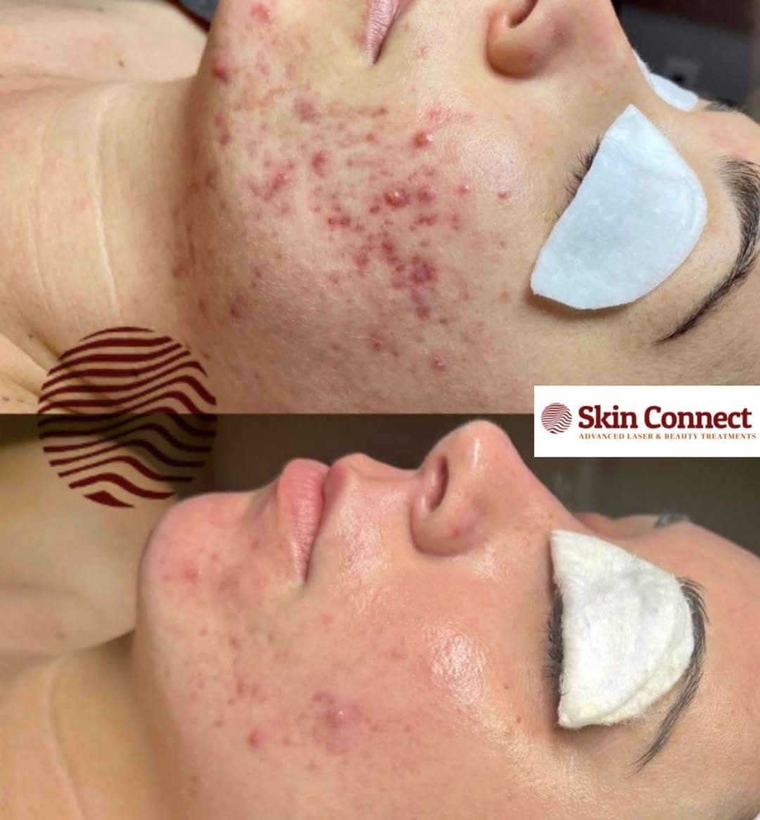 Post 4 by Laser Hair & Skin Clinic on Instagram (image)