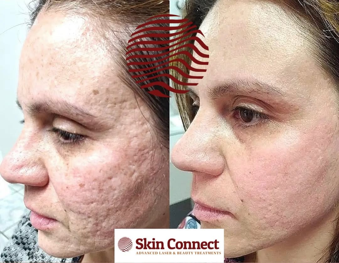Post 1 by Laser Hair & Skin Clinic on Instagram (image)