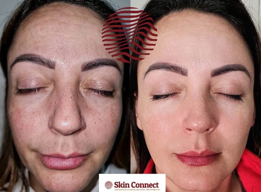 Post 9 by Laser Hair & Skin Clinic on Instagram (carousel)