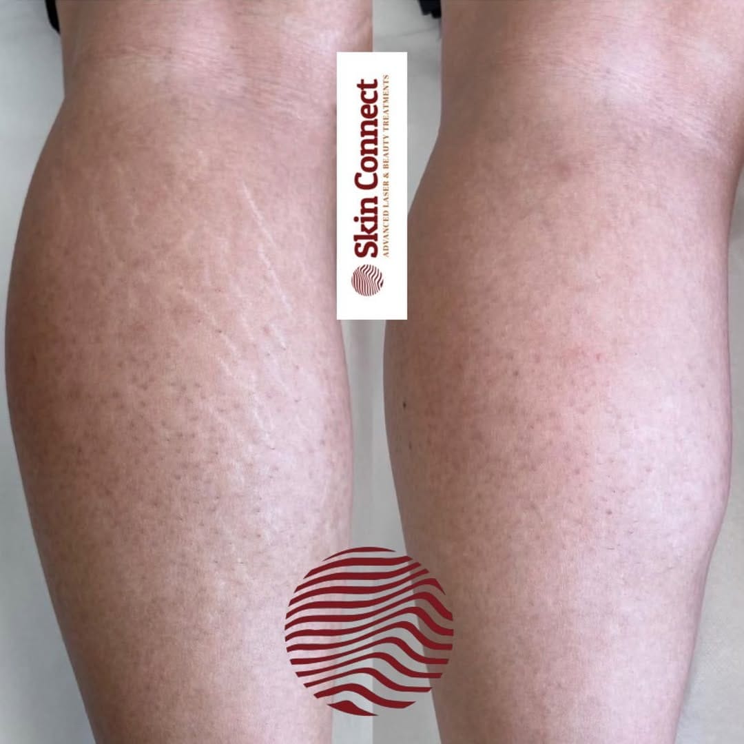 Post 8 by Laser Hair & Skin Clinic on Instagram (carousel)