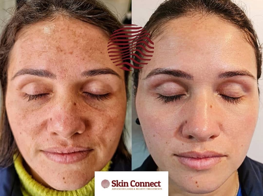 Post 5 by Laser Hair & Skin Clinic on Instagram (image)