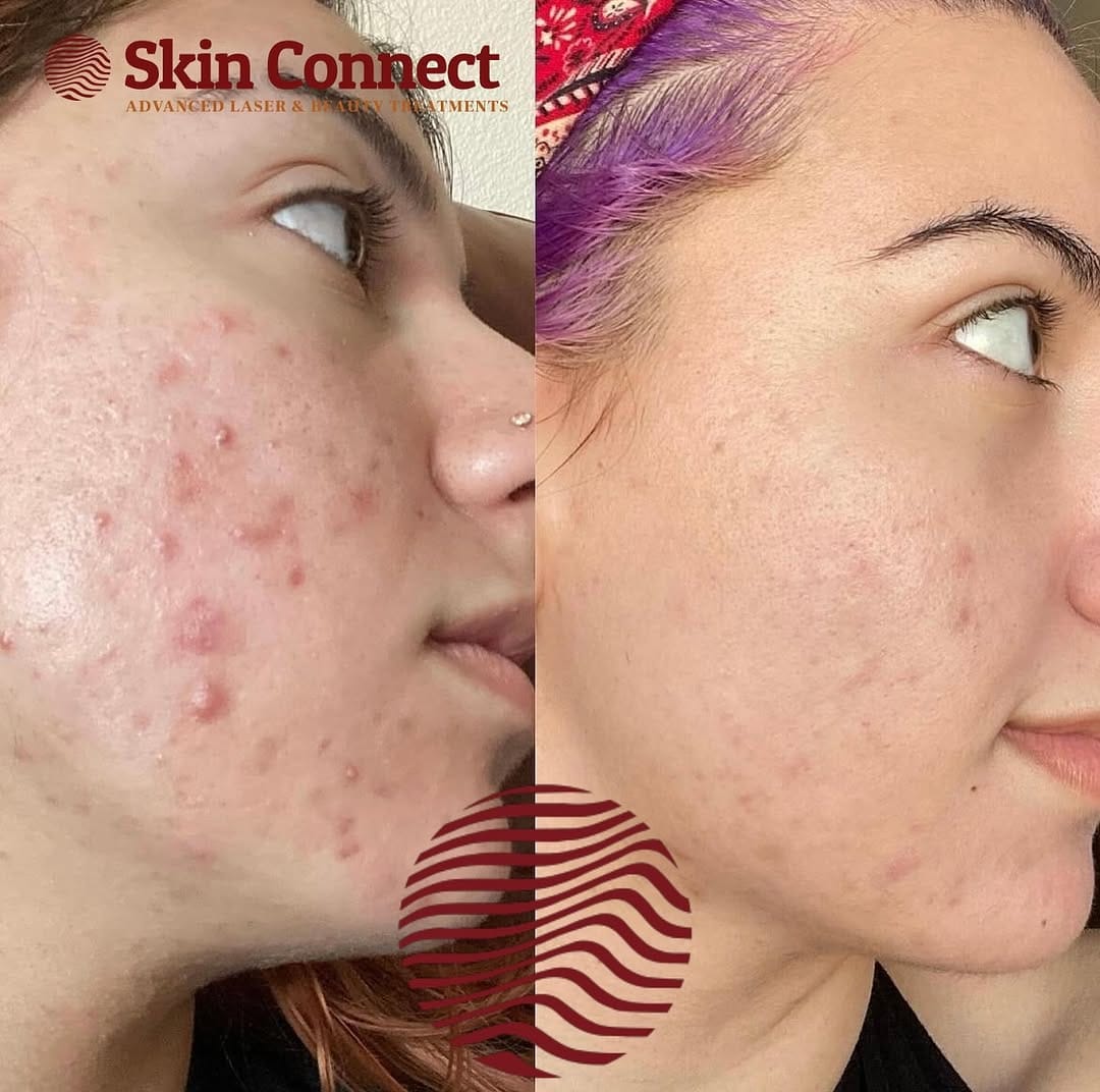 Post 2 by Laser Hair & Skin Clinic on Instagram (image)