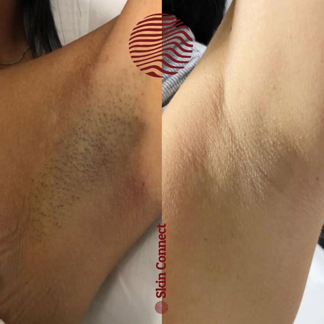 Post 10 by Laser Hair & Skin Clinic on Instagram (image)