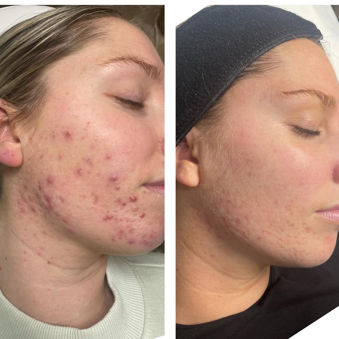 Post 10 by Skin By Katy Spelzini on Instagram (image)