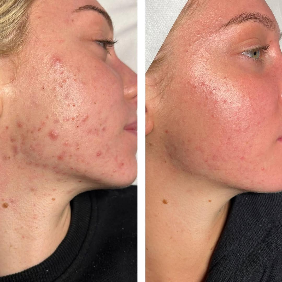 Post 8 by Skin By Katy Spelzini on Instagram (image)
