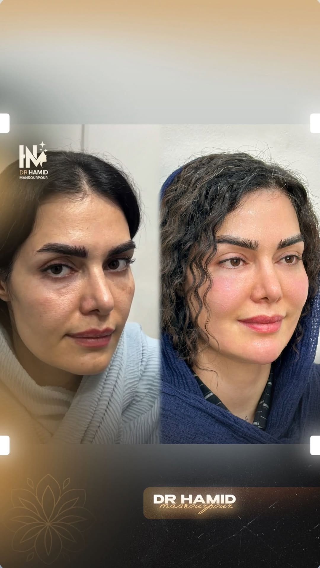 Post 5 by Dr. Hamid Mansourpour on Instagram (video)