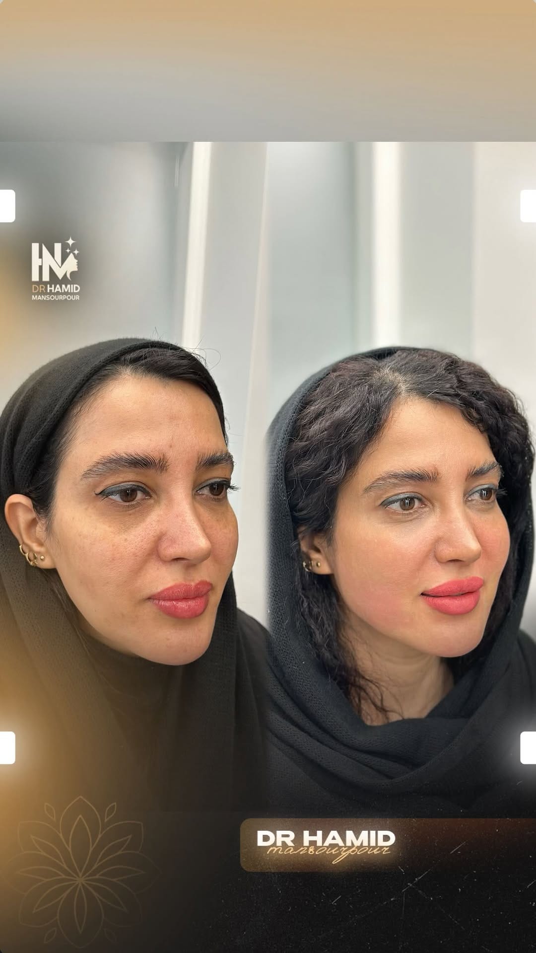 Post 9 by Dr. Hamid Mansourpour on Instagram (video)