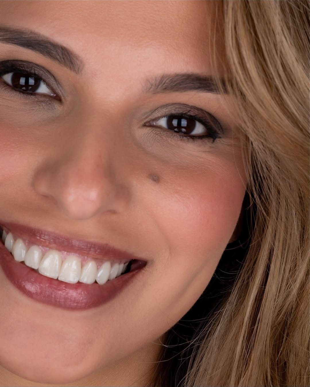 Post 4 by epic smile clinic on Instagram (carousel)