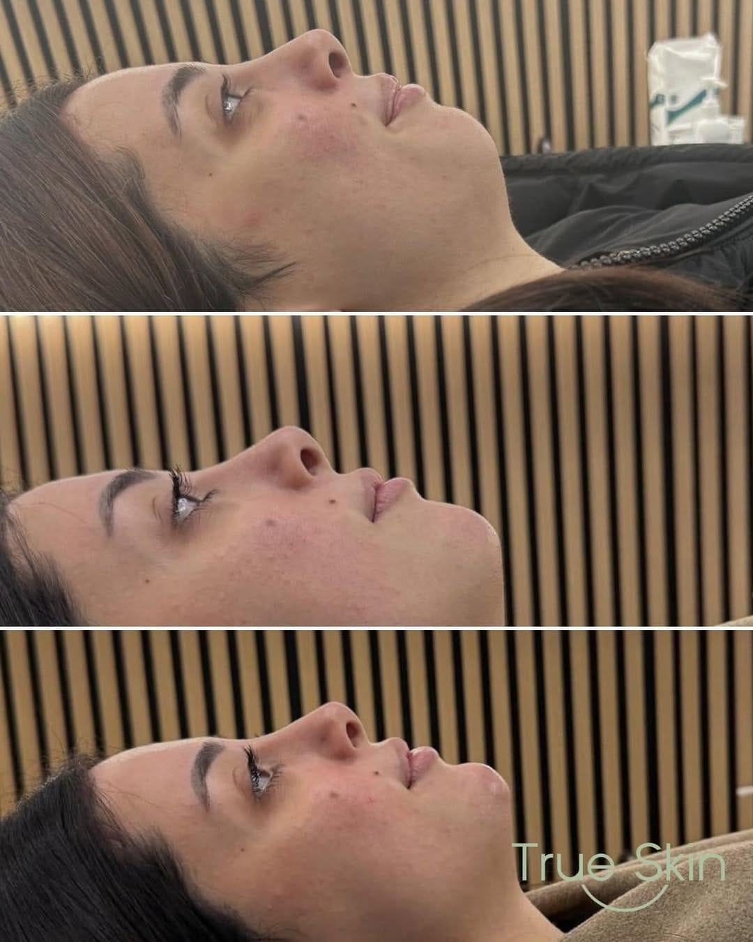 Post 4 by TrueSkin - Lip Fillers & Smooth Skin on Instagram (image)