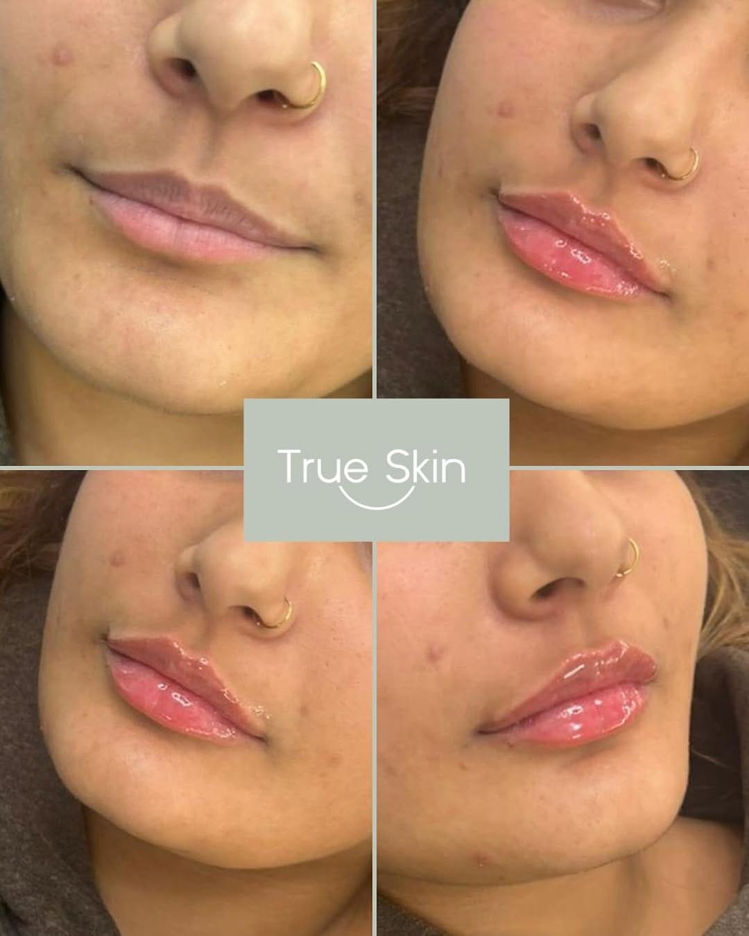 Post 7 by TrueSkin - Lip Fillers & Smooth Skin on Instagram (image)
