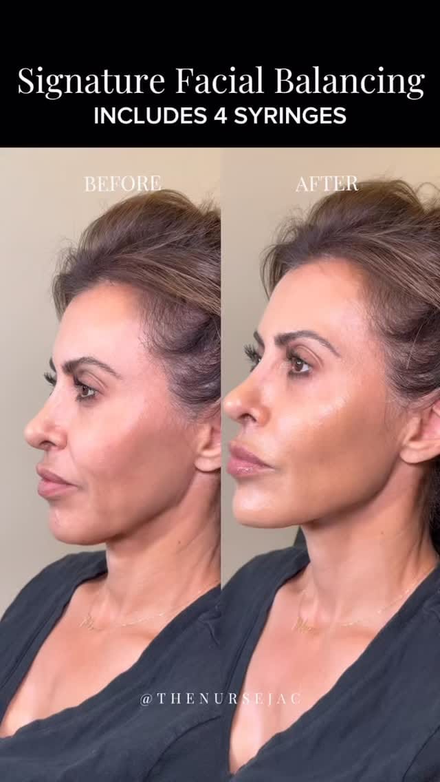 Post 10 by Nurse Jacqueline | OC Injector on Instagram (video)