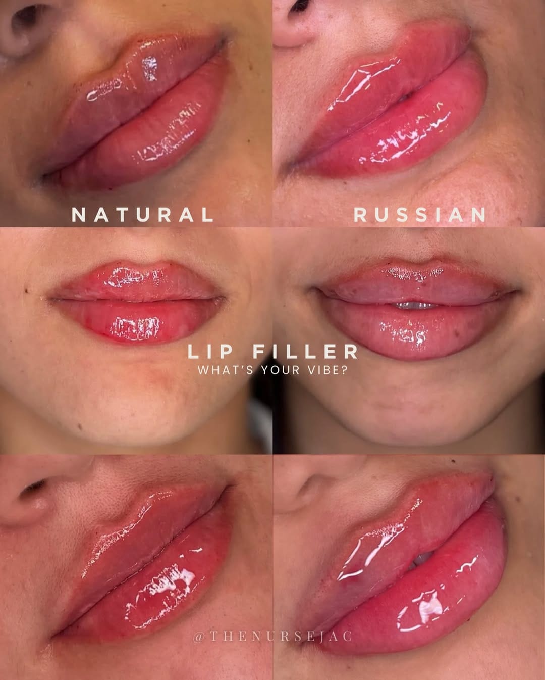 Post 8 by Nurse Jacqueline | OC Injector on Instagram (image)