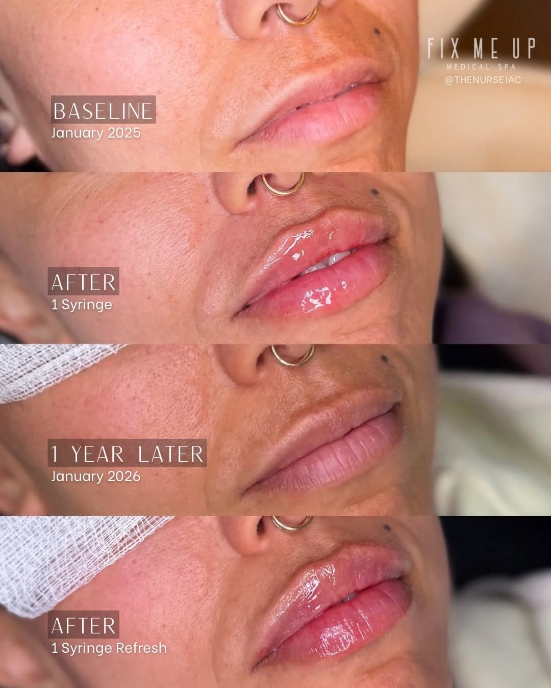 Post 3 by Nurse Jacqueline | OC Injector on Instagram (carousel)