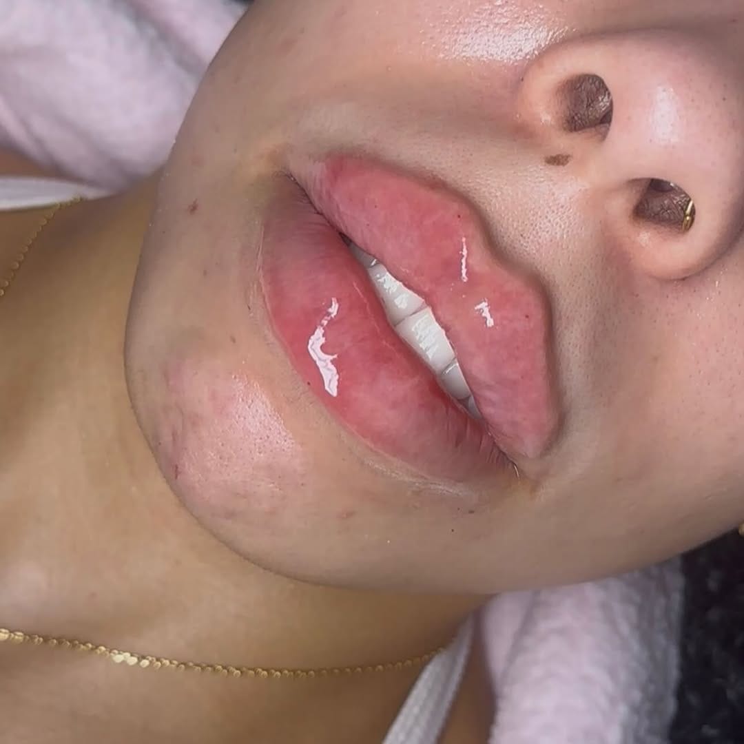 Post 1 by OLIVIA ALICE - SKIN | LASH | AESTHETICS & BROWS - NOTTINGHAM on Instagram (carousel)