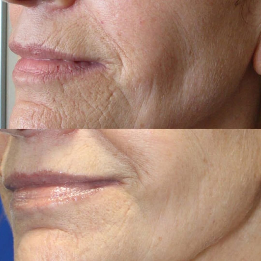 Post 5 by UNBELIEVA’BROW - SPMU ARTIST|MICROBLADING|LEMONBOTTLE on Instagram (image)