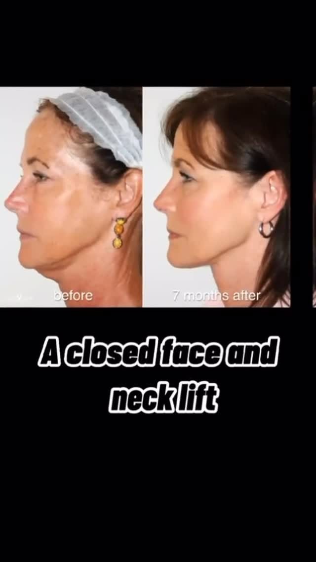 Post 5 by Dr. Yan Trokel - Y LIFT® on Instagram (video)