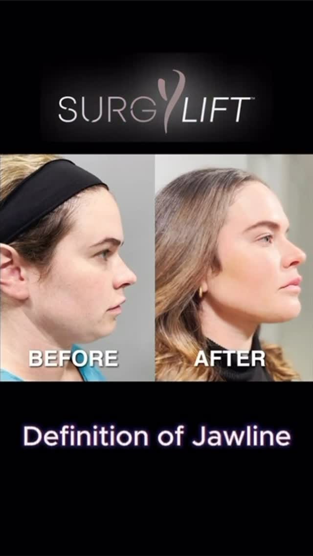 Post 8 by Dr. Yan Trokel - Y LIFT® on Instagram (video)