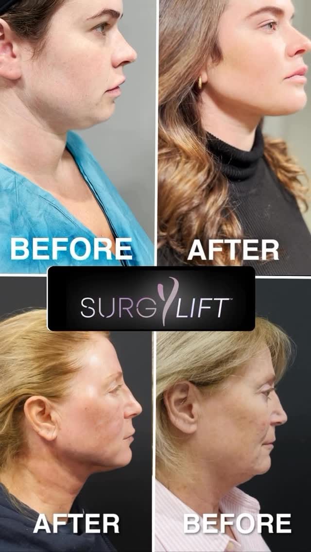 Post 6 by Dr. Yan Trokel - Y LIFT® on Instagram (video)