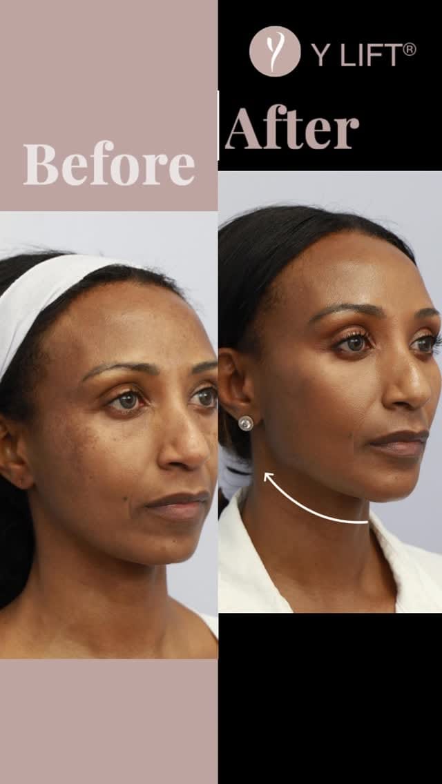 Post 2 by Dr. Yan Trokel - Y LIFT® on Instagram (video)