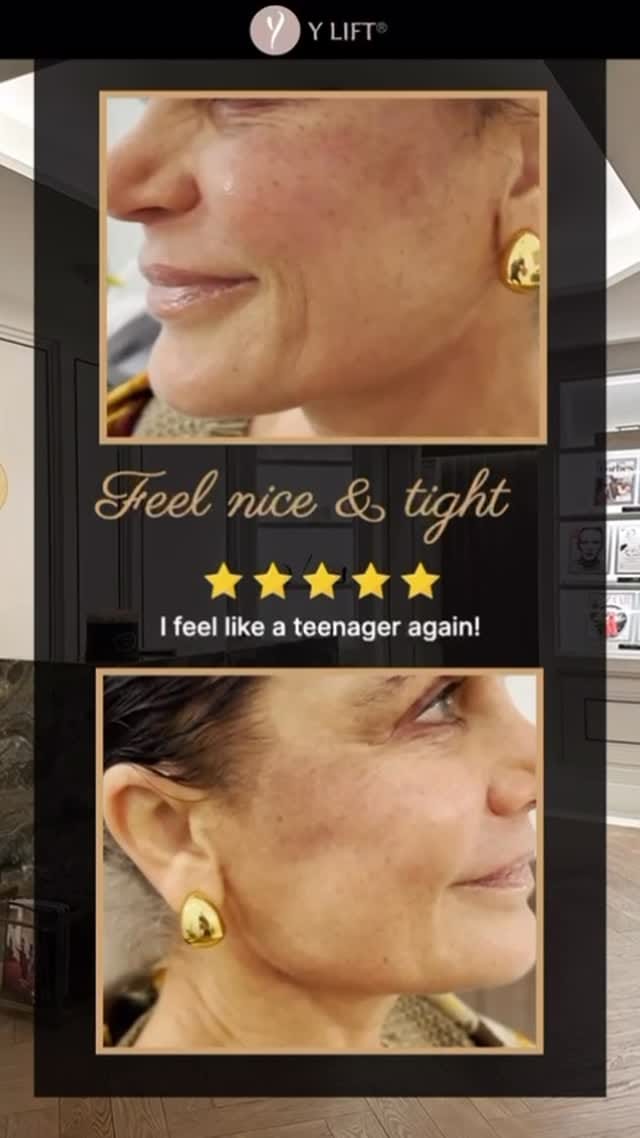 Post 9 by Dr. Yan Trokel - Y LIFT® on Instagram (video)