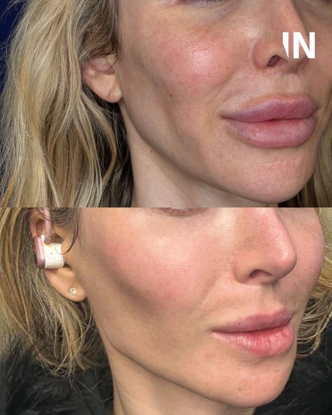 Post 5 by Injectual Injectables: #1 Polynucleotides, Profhilo & Filler on Instagram (carousel)