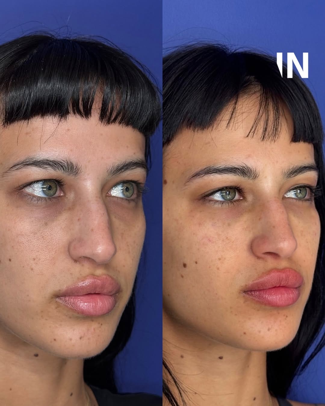 Post 10 by Injectual Injectables: #1 Polynucleotides, Profhilo & Filler on Instagram (image)