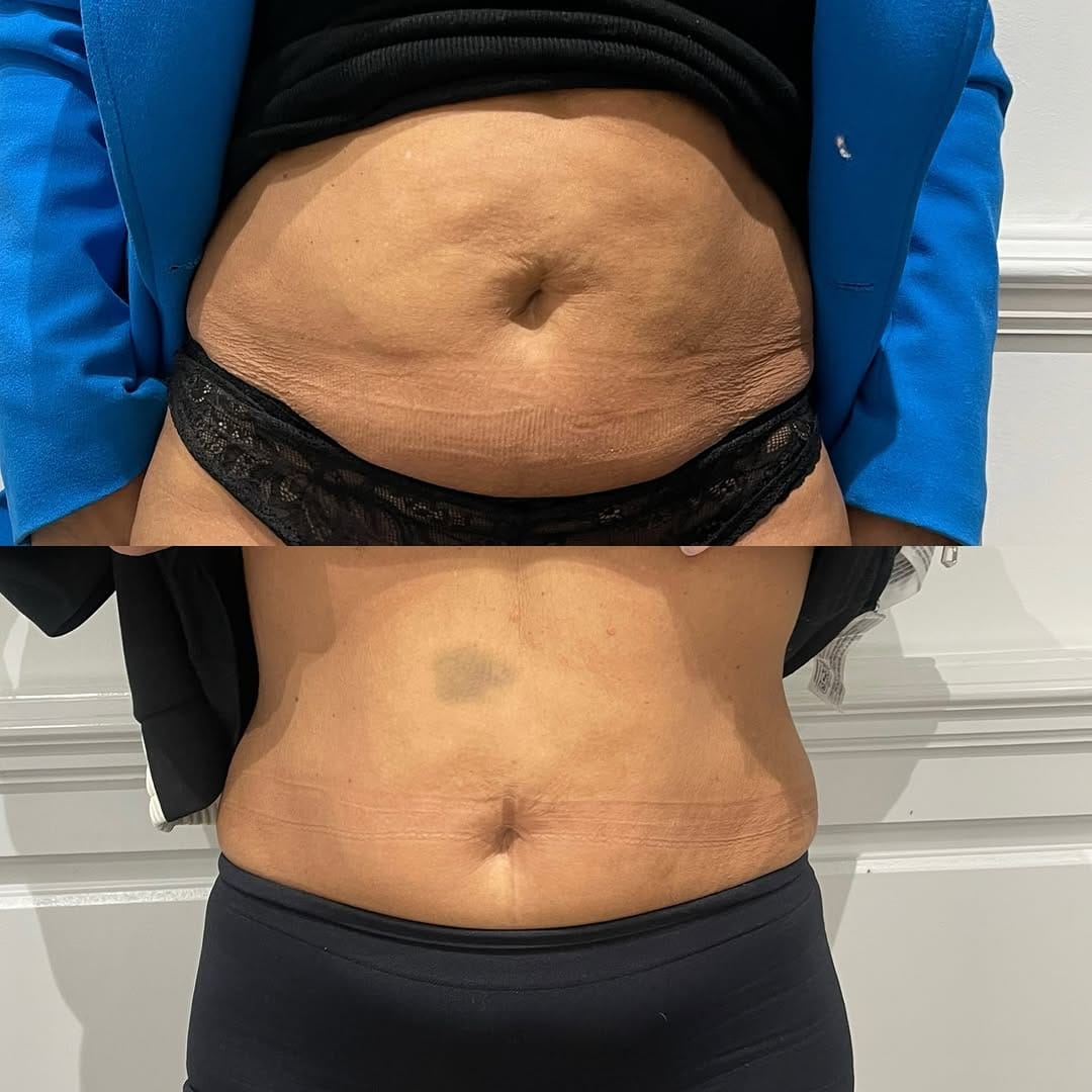 Post 2 by SLIMLINES AESTHETICS. Regenerative + Aesthetic Medicine on Instagram (image)