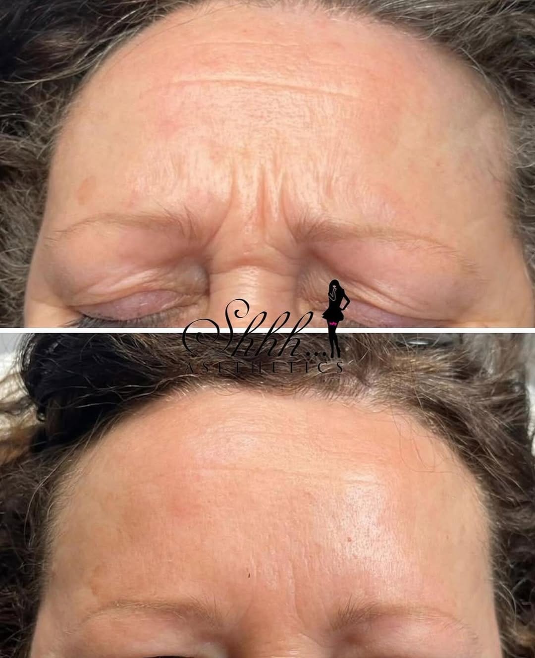 Post 1 by SKIN BOOSTERS | ANTI AGING on Instagram (image)