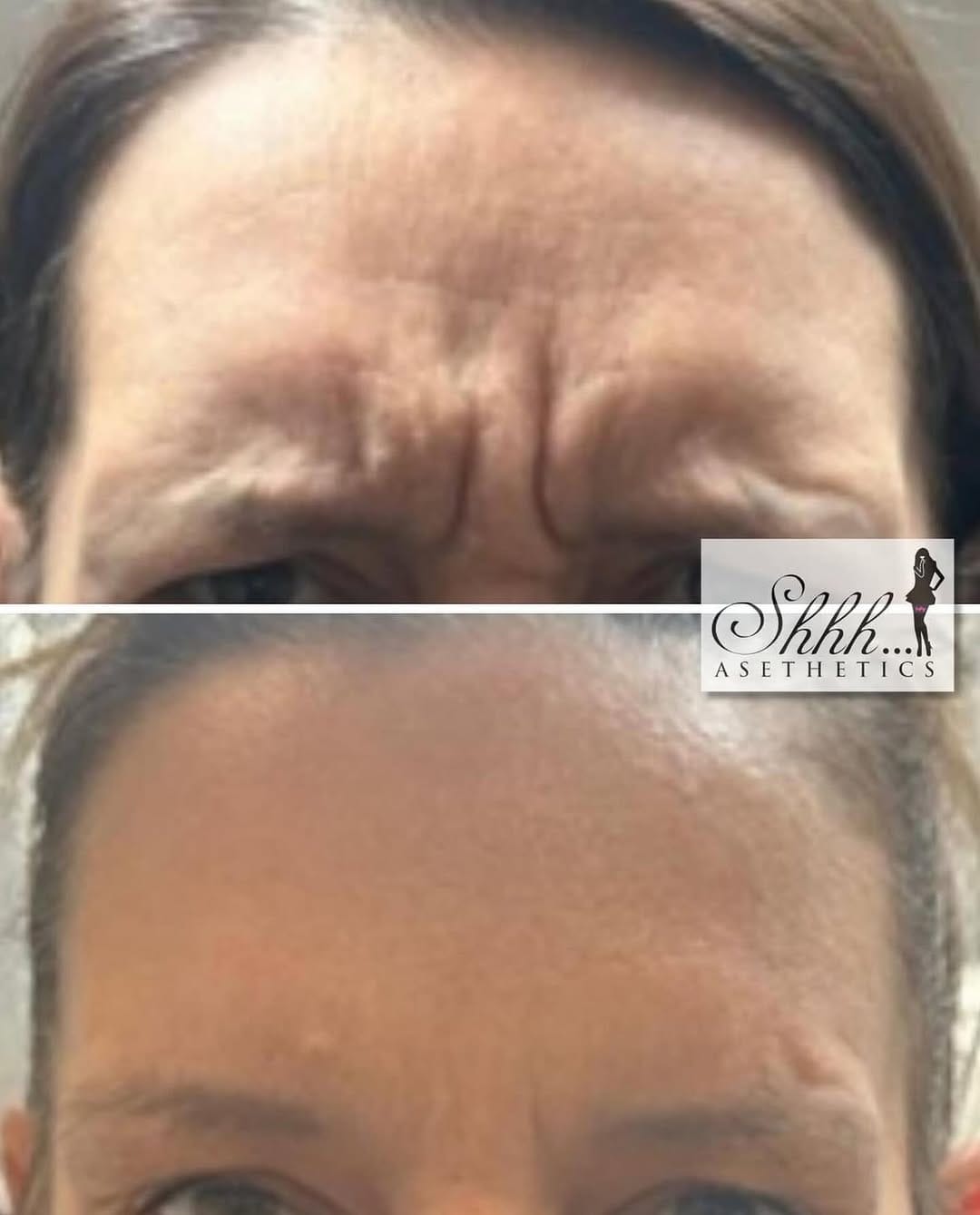 Post 10 by SKIN BOOSTERS | ANTI AGING on Instagram (image)