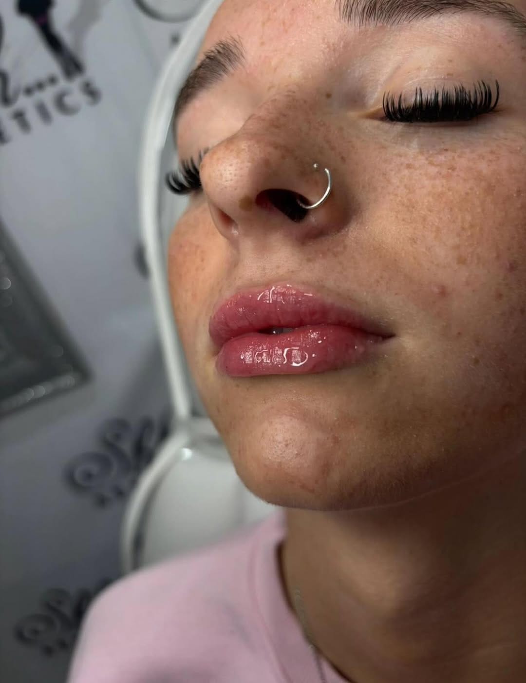 Post 9 by SKIN BOOSTERS | ANTI AGING on Instagram (image)