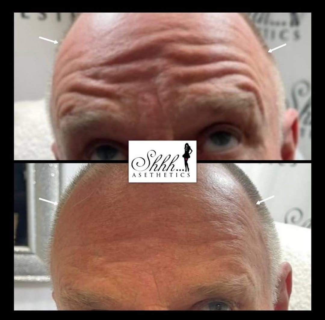 Post 3 by SKIN BOOSTERS | ANTI AGING on Instagram (image)