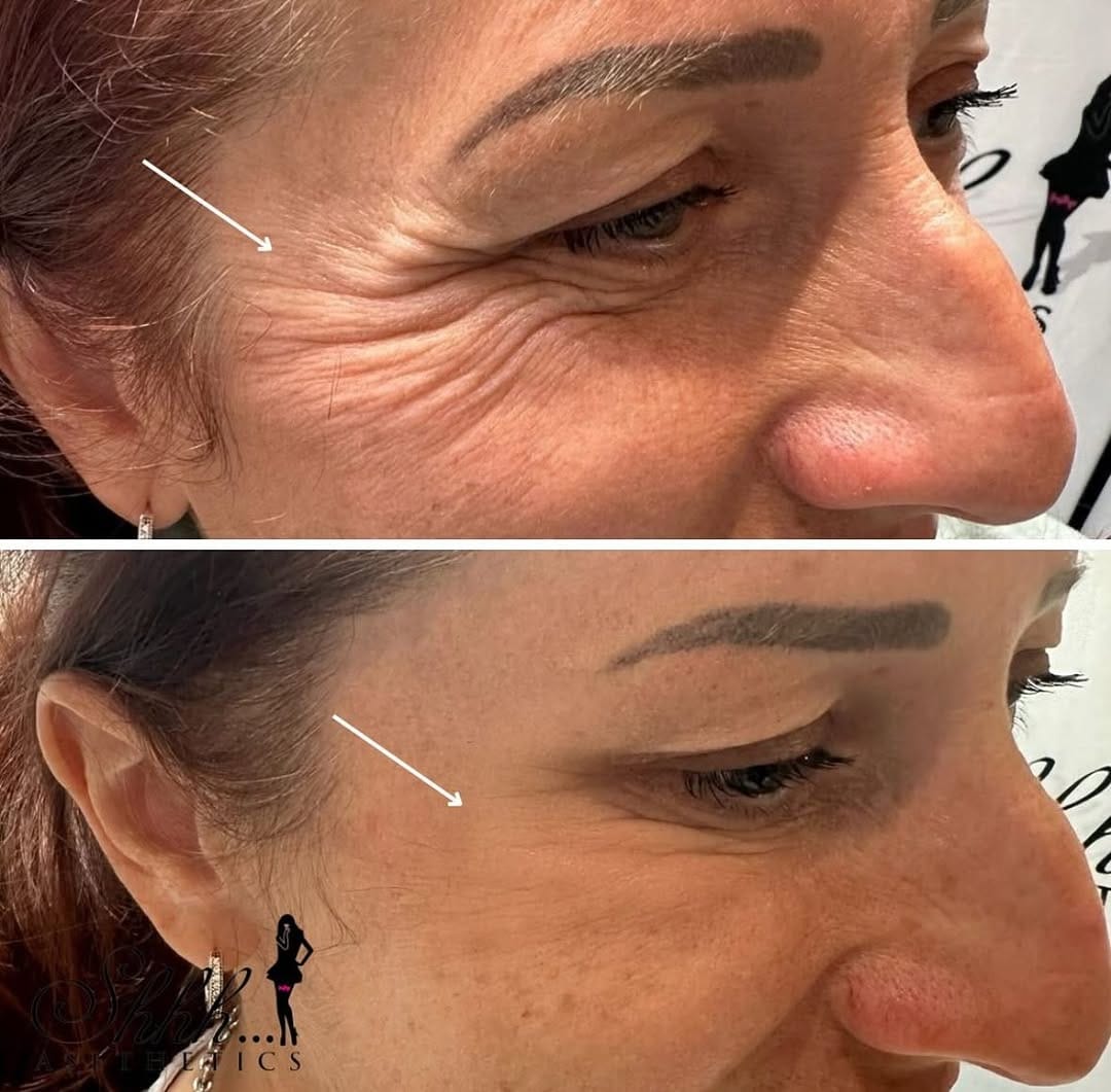 Post 6 by SKIN BOOSTERS | ANTI AGING on Instagram (image)