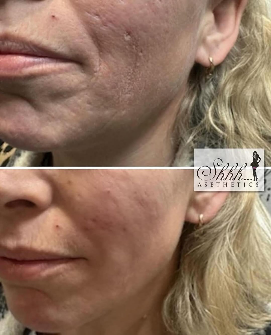 Post 4 by SKIN BOOSTERS | ANTI AGING on Instagram (image)