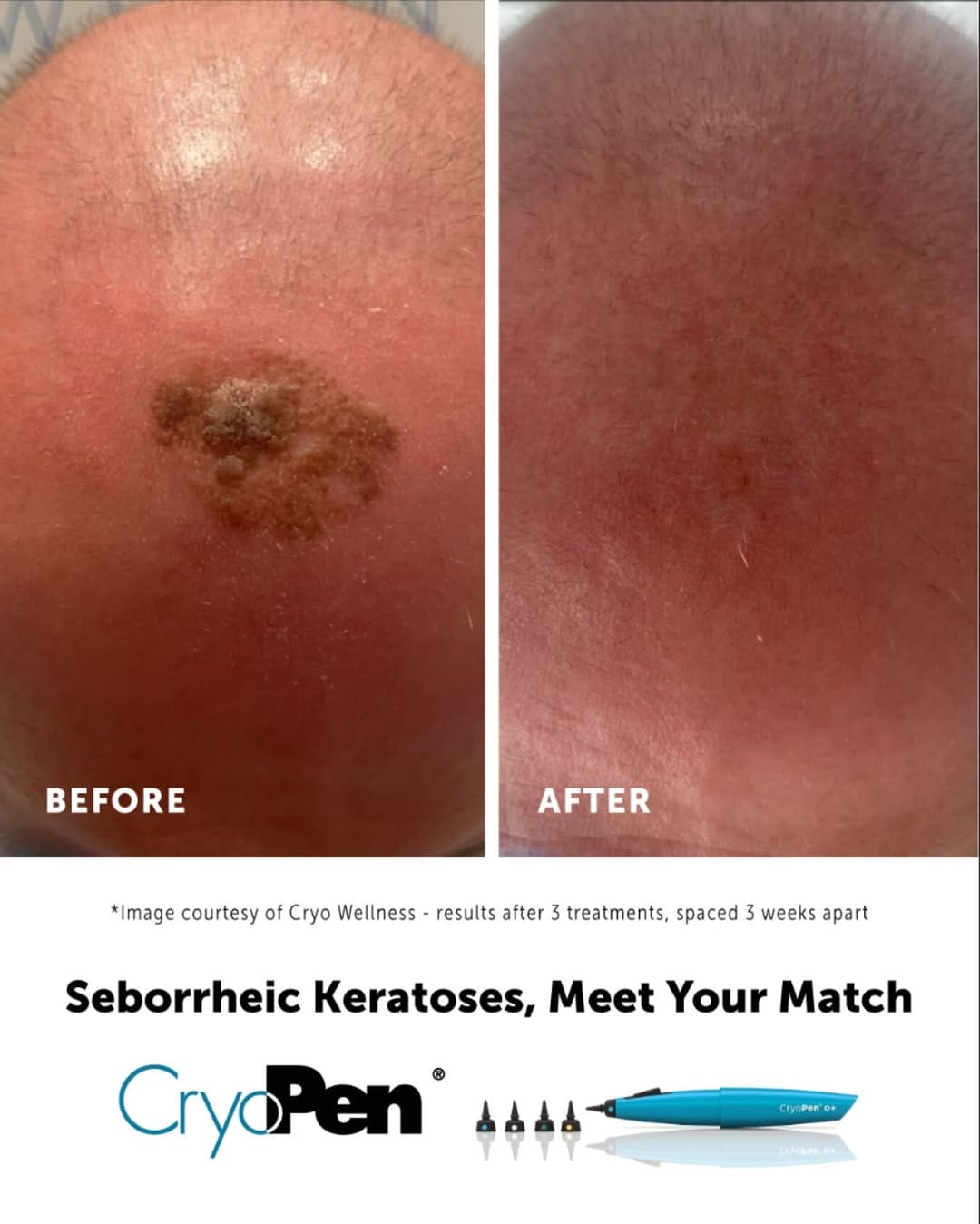 Post 4 by Essex Cryo Wellness on Instagram (image)