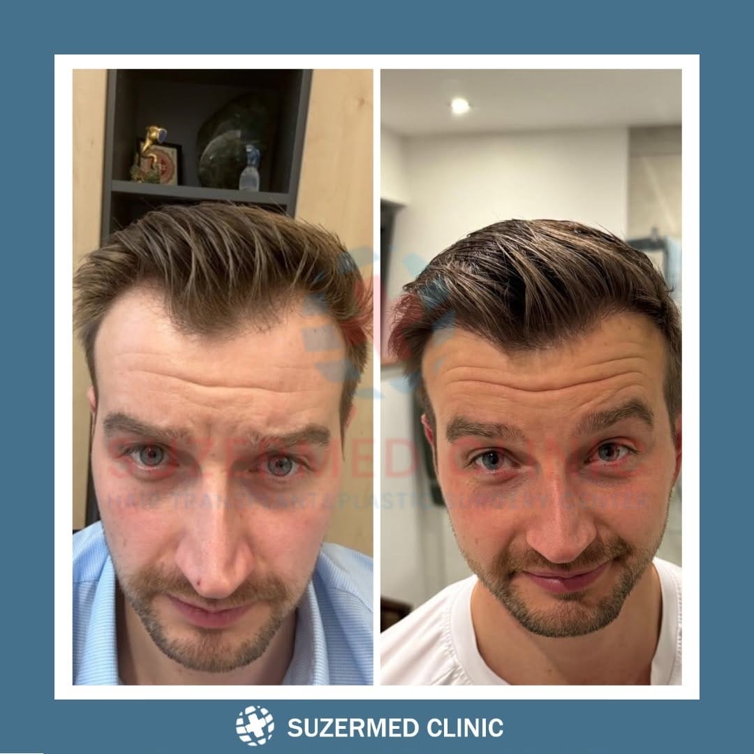 Post 9 by Suzermed Clinic on Instagram (carousel)