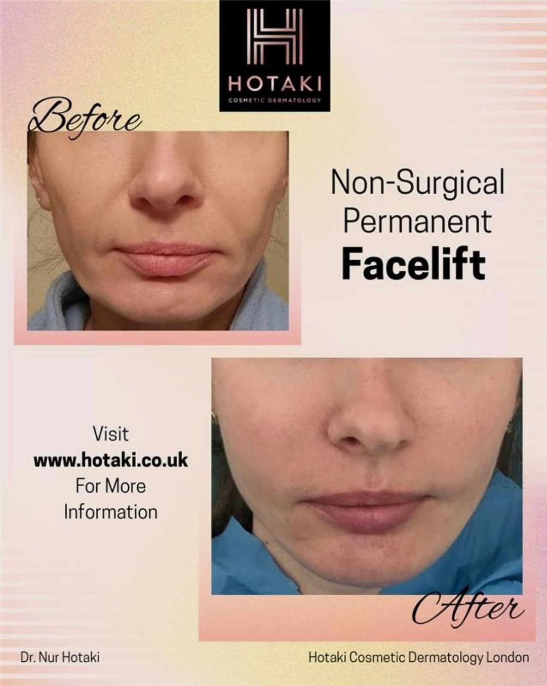 Post 9 by Hotaki Cosmetic Dermatology on Instagram (image)