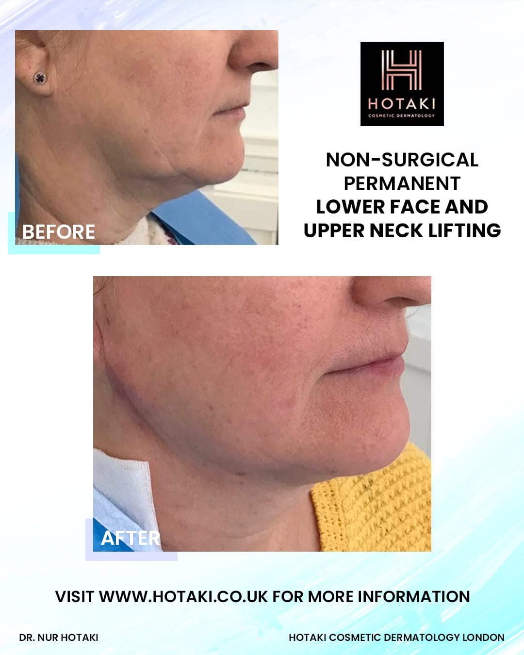 Post 4 by Hotaki Cosmetic Dermatology on Instagram (image)