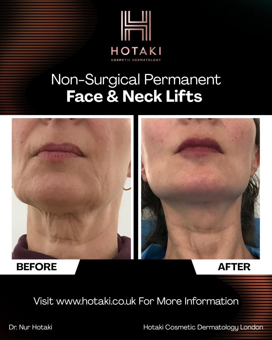 Post 10 by Hotaki Cosmetic Dermatology on Instagram (image)