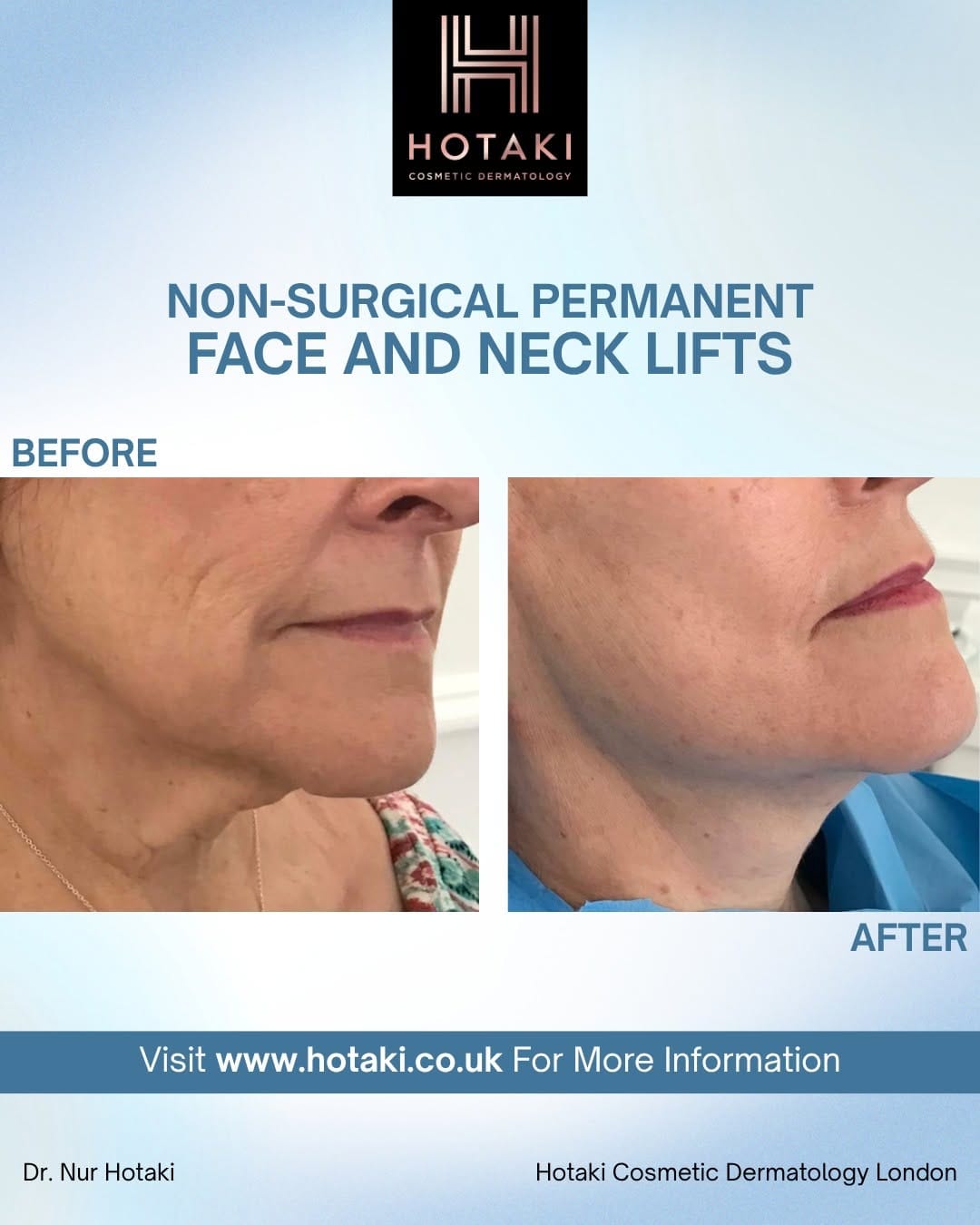 Post 8 by Hotaki Cosmetic Dermatology on Instagram (image)