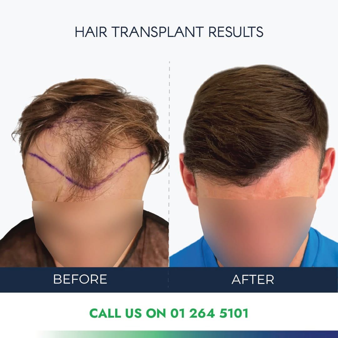 Post 10 by Ailesbury Hair Fleming Place Clinic on Instagram (image)
