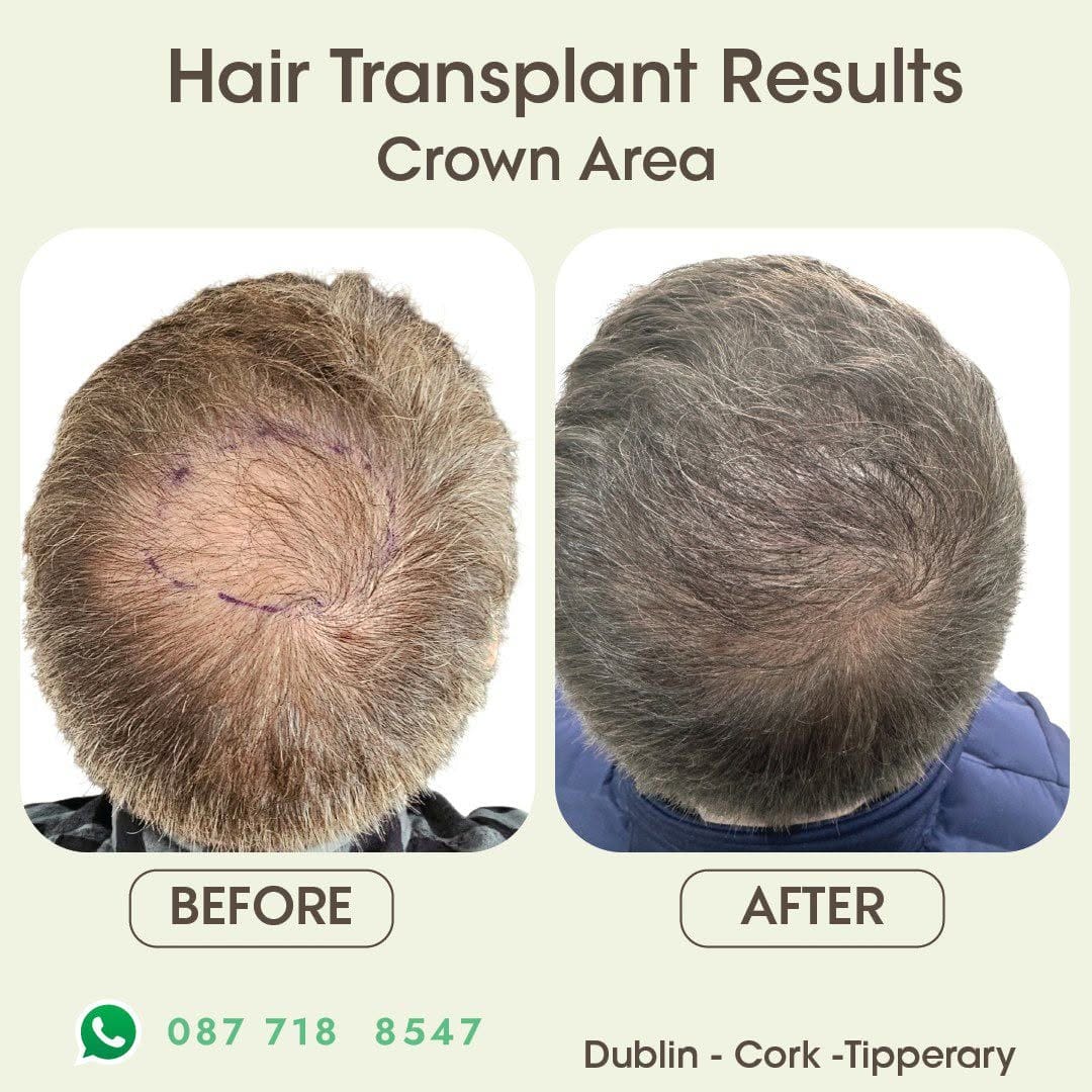 Post 6 by Ailesbury Hair Fleming Place Clinic on Instagram (image)