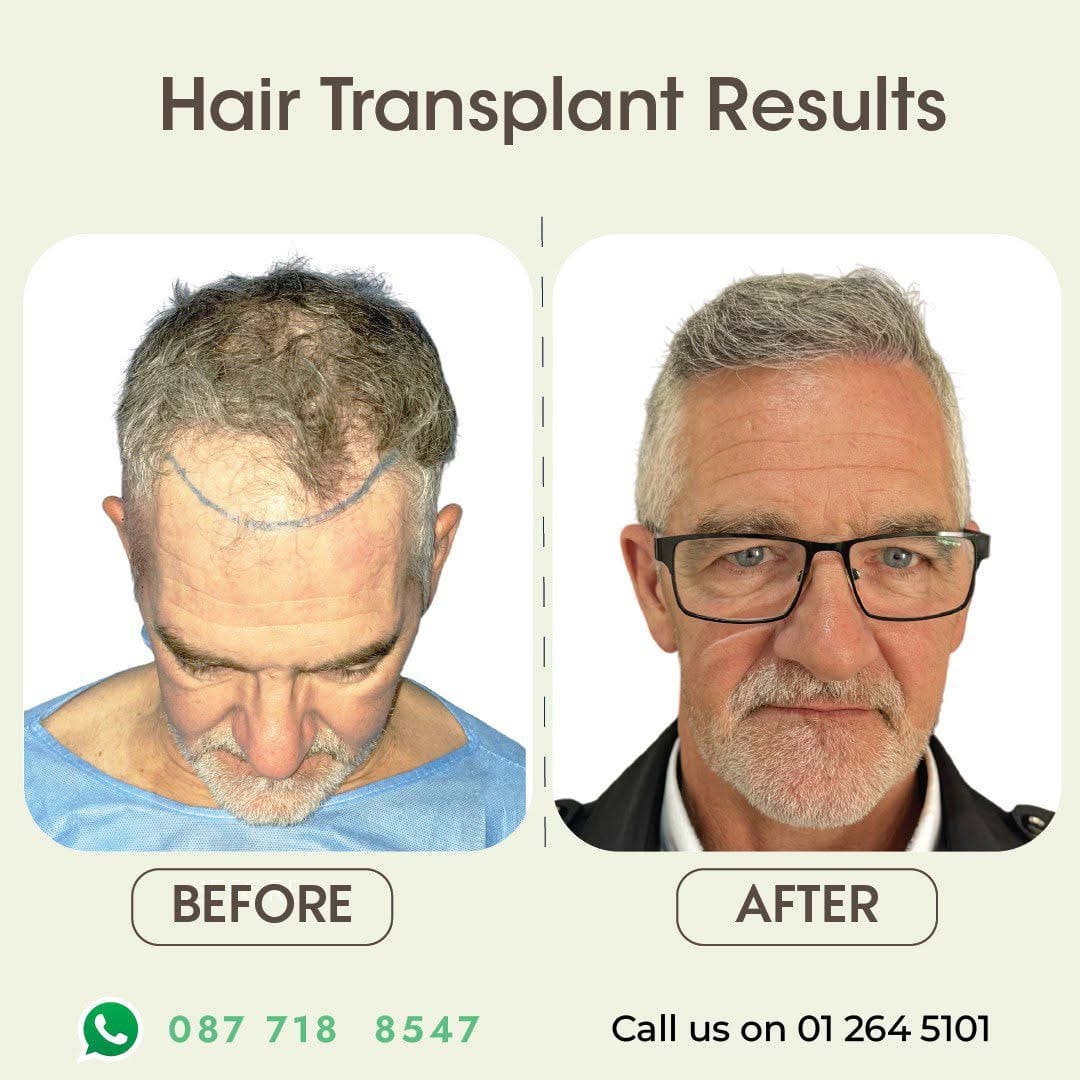 Post 2 by Ailesbury Hair Fleming Place Clinic on Instagram (carousel)