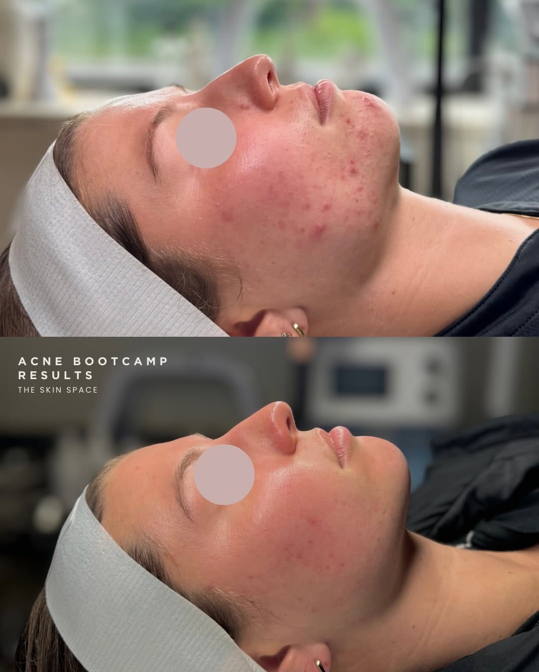 Post 2 by The Skin Space | Acne Specialist on Instagram (carousel)