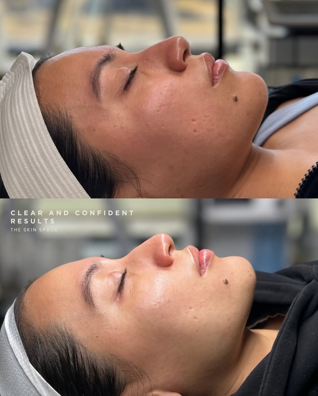 Post 4 by The Skin Space | Acne Specialist on Instagram (carousel)