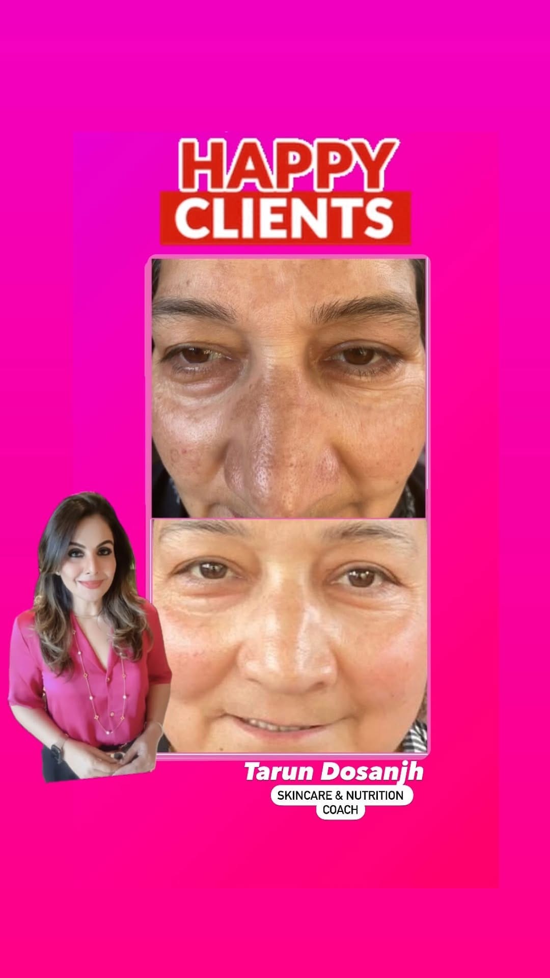 Post 10 by Tarun K Dosanjh | Skin & Hair Correction on Instagram (video)