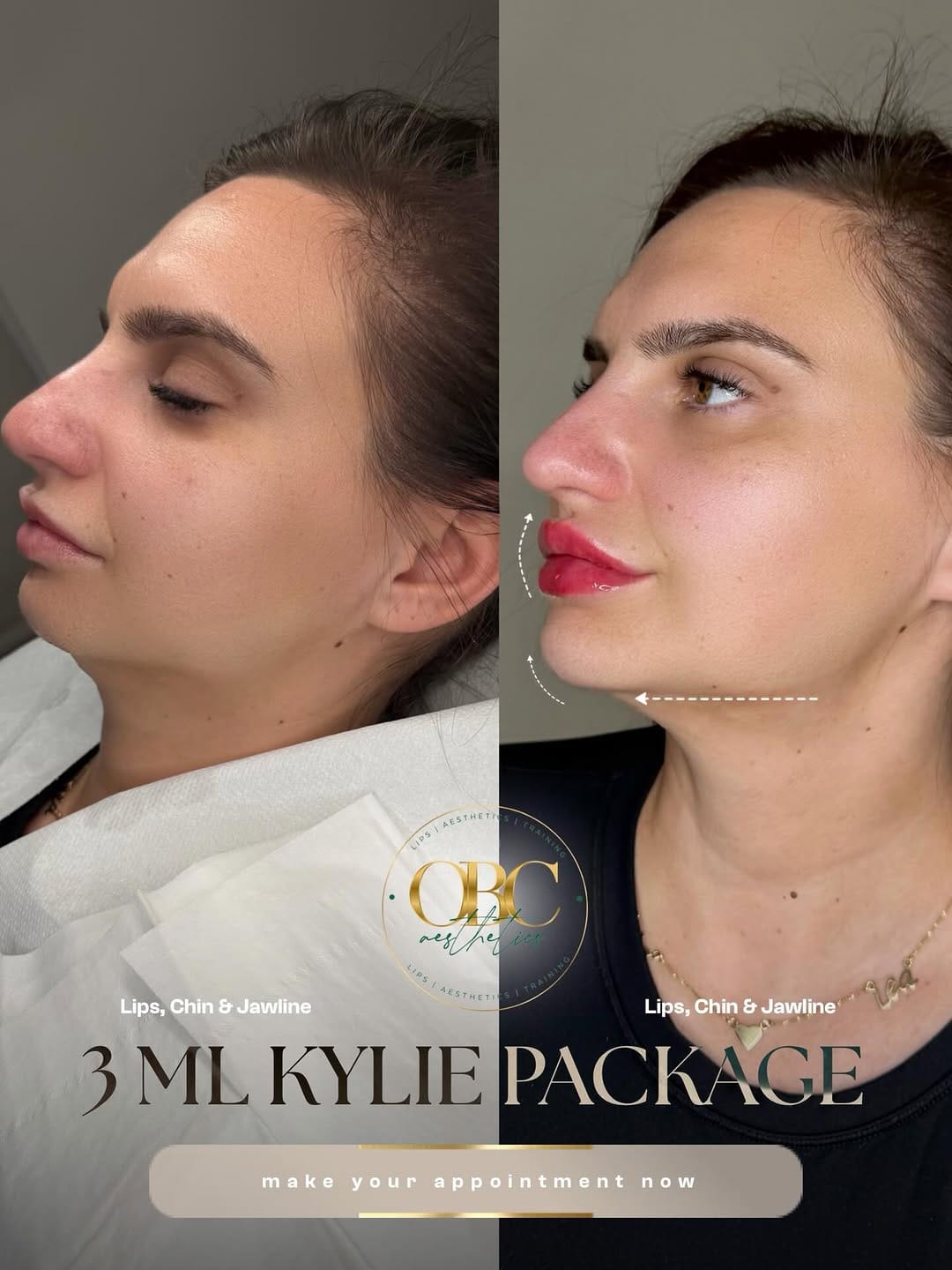 Post 6 by RUSSIAN LIPS, FILLERS, STRIP/LIPS, AESTHETICS & TRAINING on Instagram (image)