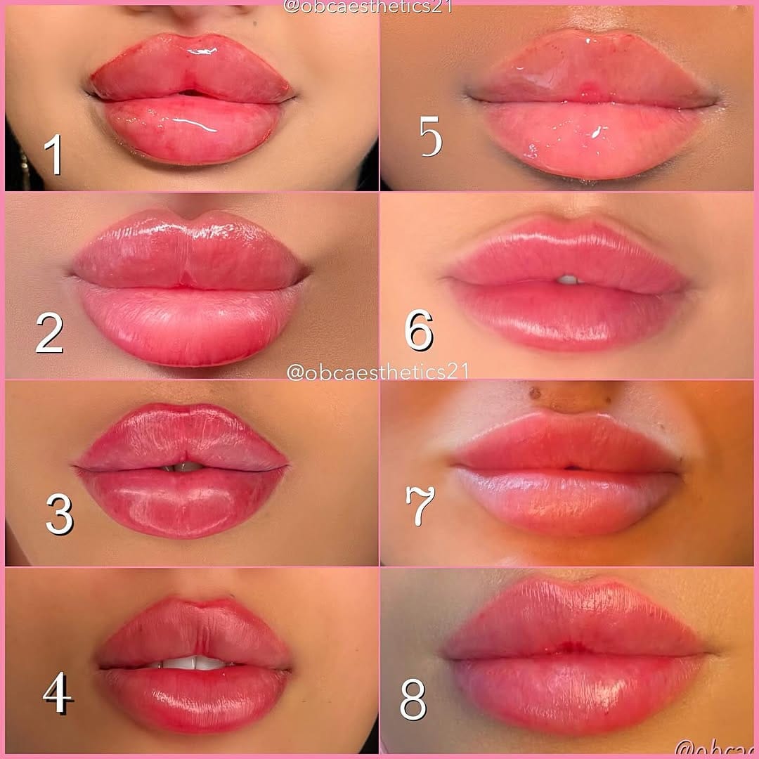 Post 9 by RUSSIAN LIPS, FILLERS, STRIP/LIPS, AESTHETICS & TRAINING on Instagram (image)