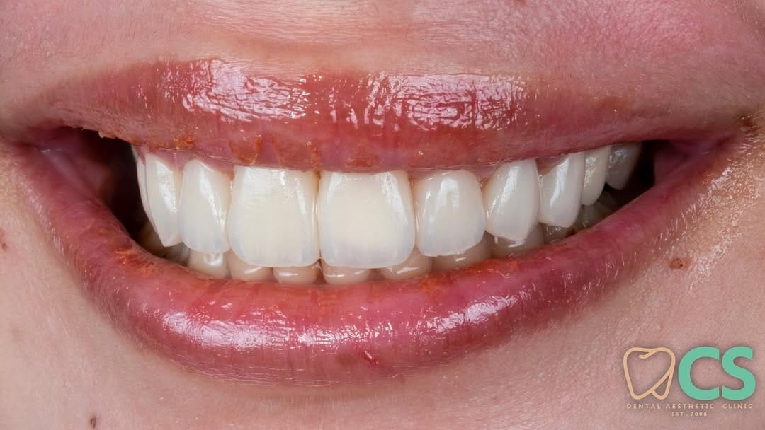 Post 10 by KLINIK GIGI • DOKTER GIGI • CS DENTAL LAB JAKARTA on Instagram (carousel)