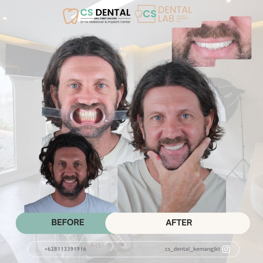 Post 3 by KLINIK GIGI • DOKTER GIGI • CS DENTAL LAB JAKARTA on Instagram (carousel)